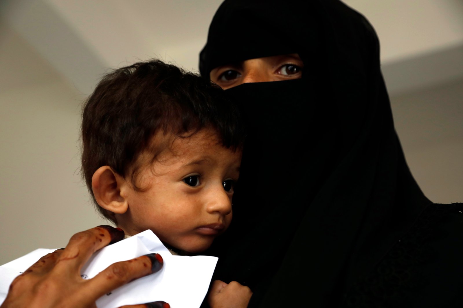 Jemen. Niedożywione dzieci EPA/YAHYA ARHAB 
